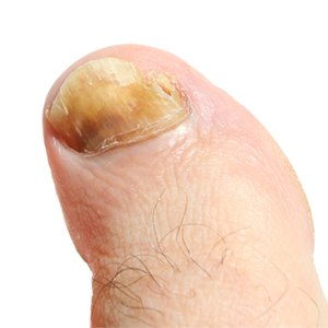 Discolored and thickened toenail caused by fungal infection.